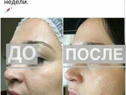 Мезотерапия